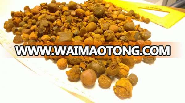 gallstones